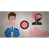 No More "Wild Measles," Only Vaccine Genotypes?