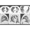 Doctors Puzzle Over COVID-19 Lung Problems ( high pressure ventilators, just like leaches?)