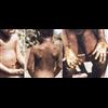 Horrible "Nigerian disease" called Monkeypox spreads in UK for first time - ( Who let it come to Britain? Few seem to think about unpleasant things, until "out of the blue", ( it ) happens to them.)